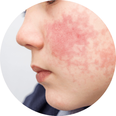 Sterilair Alergia ao mofo